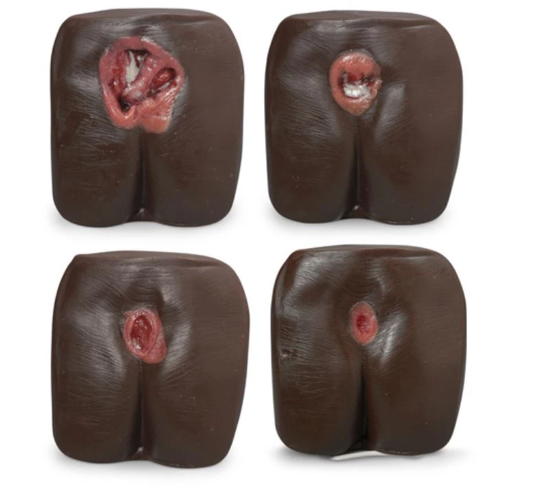 Nasco Healthcare Bedsore/Pressure Ulcer Anatomical Model