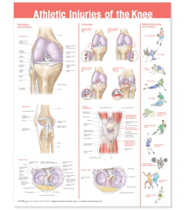 Athletic Injuries of the Knee Anatomical Chart, 20" x 26", Each