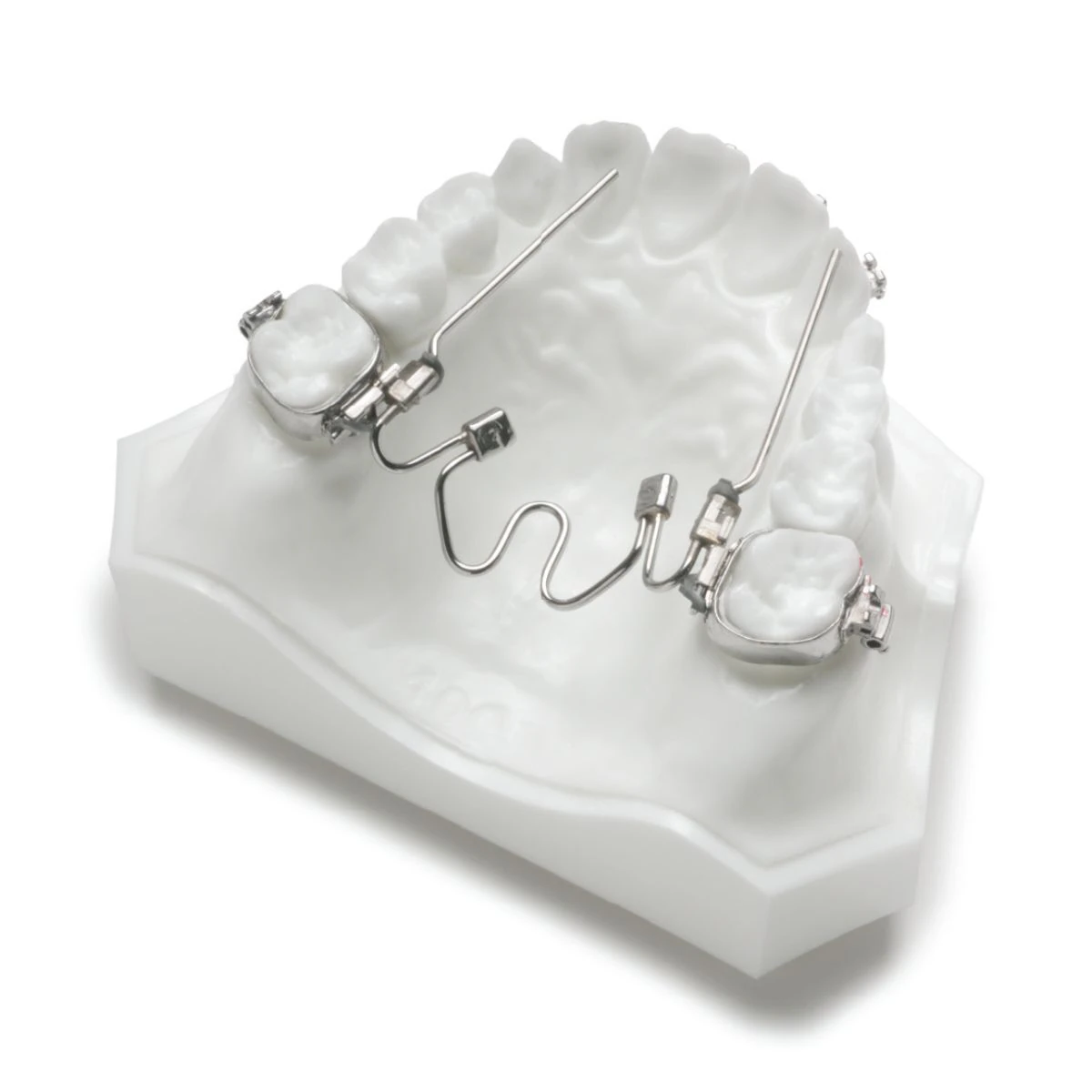 Nitanium Palatal Expander 2, 30mm