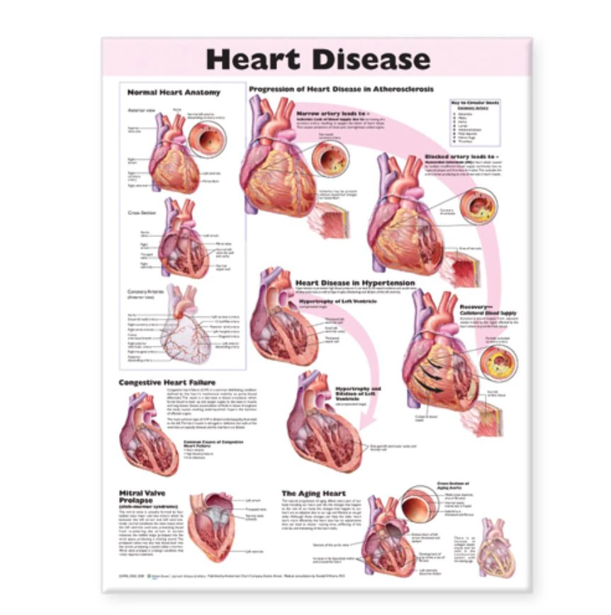 Heart Disease Educational Chart, 20" x 26", Flexible, Each