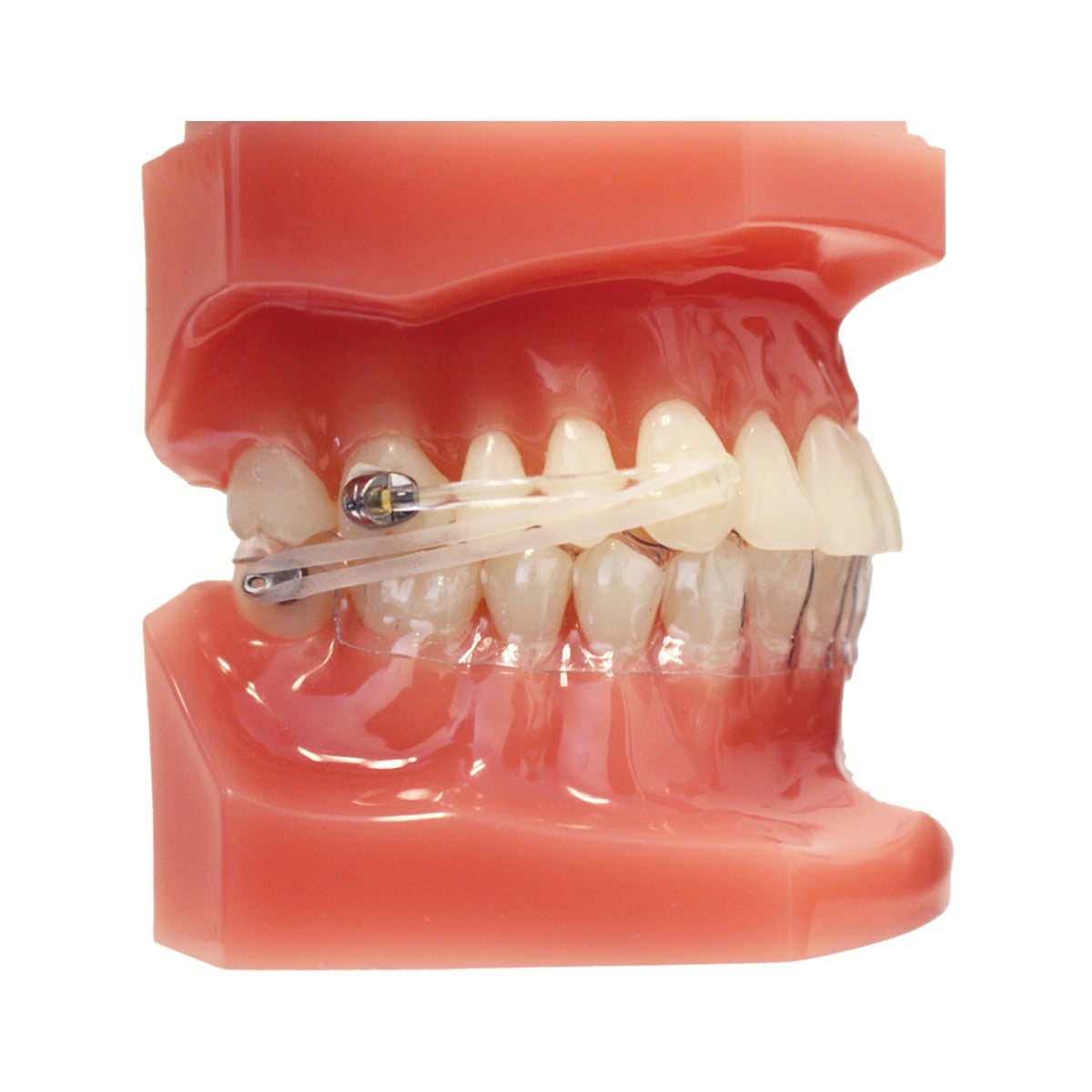 Carriere Motion 3D Clear Class II Typodont