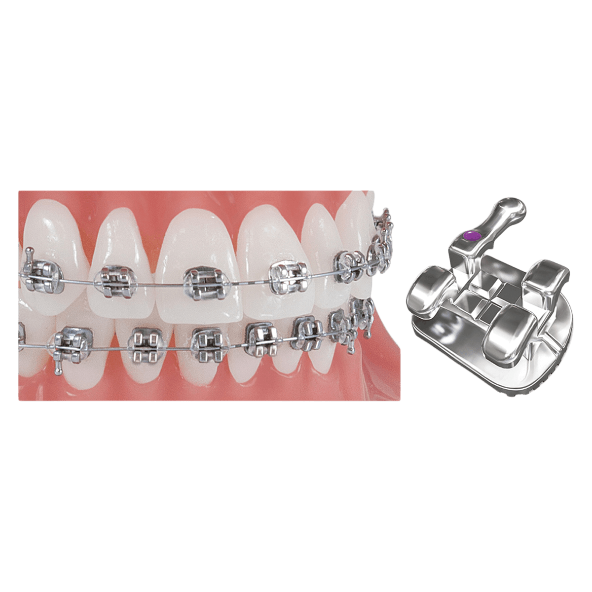 Pinnacle MBT Individual Bracket, Upper Right Central (UR1), 0.022 in, 10/Box