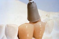Shofu Ceramiste CA Bullet Polisher, Standard Grit, No Band, 12/Pkg, 0251