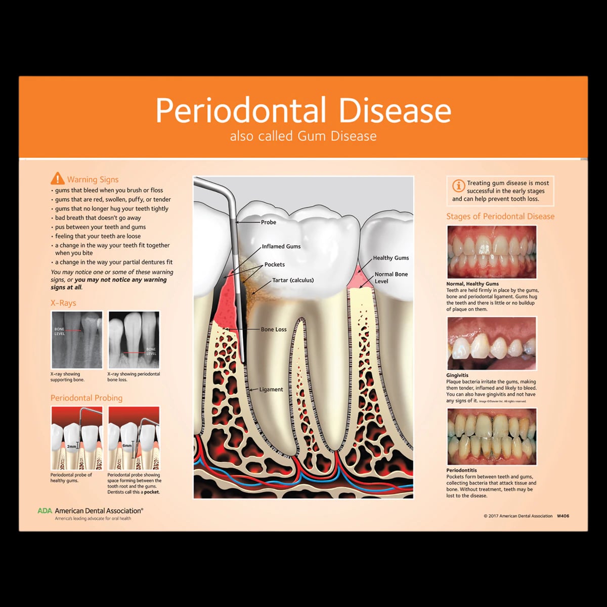 American Dental Assn Poster Periodontal Disease, 16 in x 20 in, Laminated, 01KEZKNTHFNEK03CQW88VHSTPX