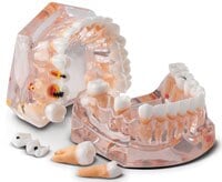 Practicon Enlarged Model for Hygiene and Caries Evolution, 32 Removable Teeth, Upper and Lower Arch, 4.25"W x 3.5"H