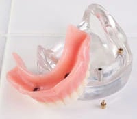 Model Implant LOC-2 Over-Denture Locator, Lower, 2 Implants