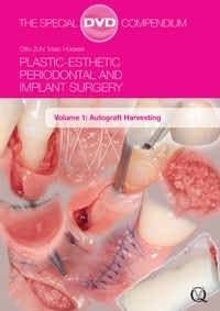 DVD Plastic-Esthetic Periodontal and Implant Surgery: Autograft Harvesting, Volume 1 (Quintessence Publishing)