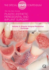 DVD Plastic-Esthetic Periodontal and Implant Surgery: Singular Gingival Recession Coverage, Volume 3