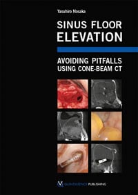 Sinus Floor Elevation: Avoiding Pitfalls Using Cone-Beam CT by Yasuhiro Nosaka, 120 pp, ISBN 978-1-85097-265-5