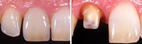 Cerpress II System Complete (American Dental Supply)