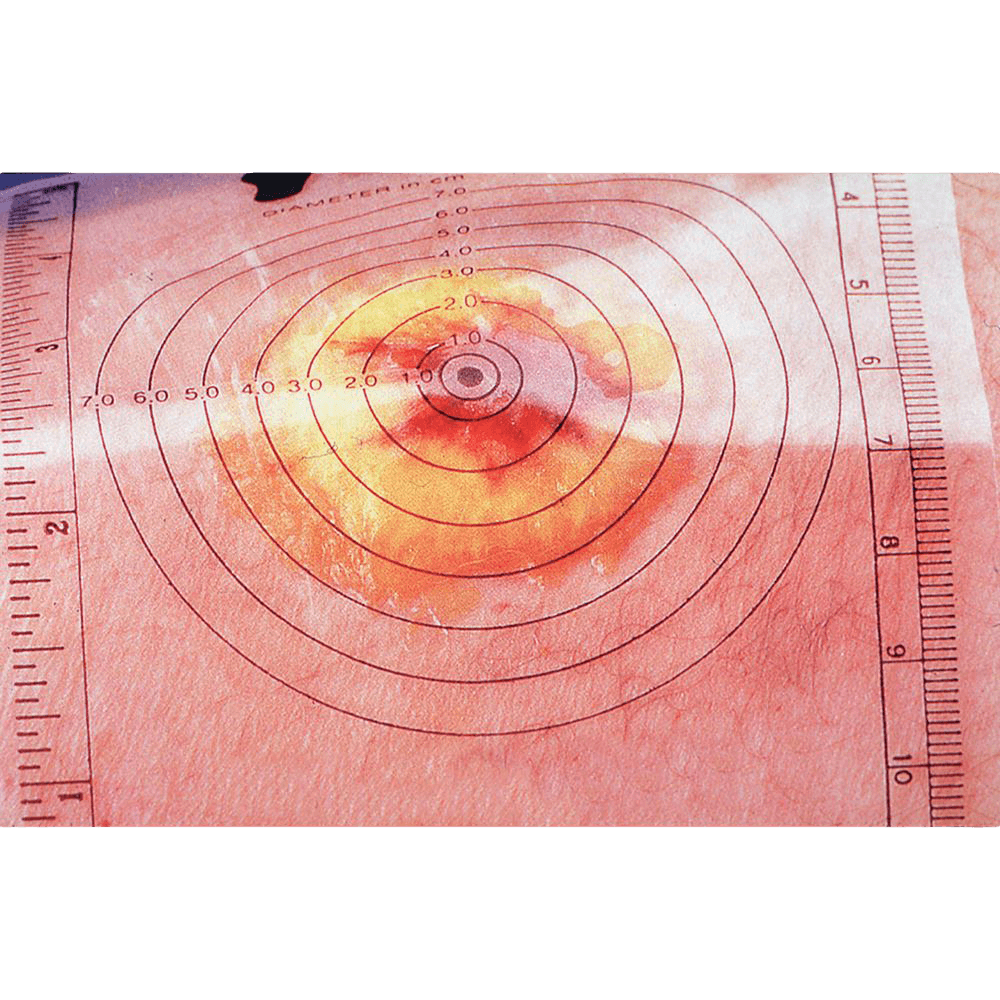 Wound Measure Device, Measuring Sheet for Wound, 250/Box