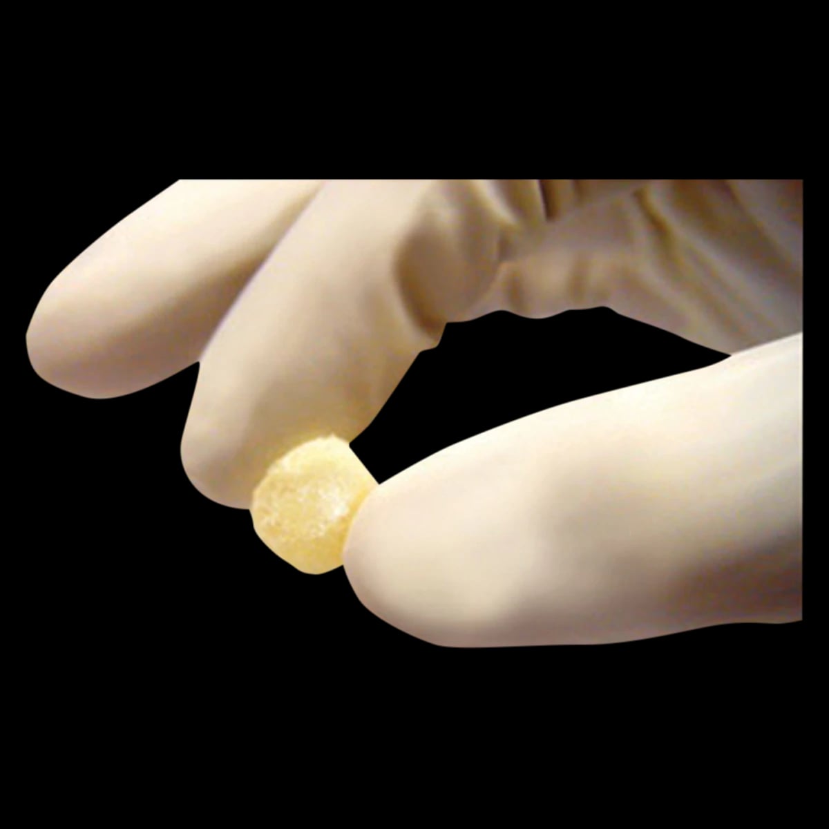 Grafton Demineralized Bone Matrix (DBM) Putty, 5 cc Syringe