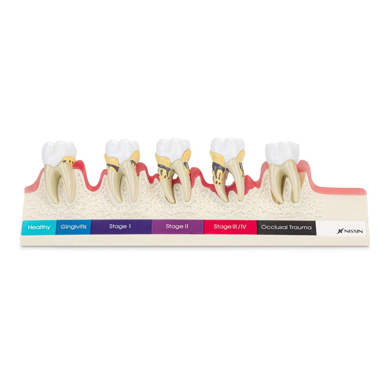 Nissin Model Periodontal Progression, 6-1/4"