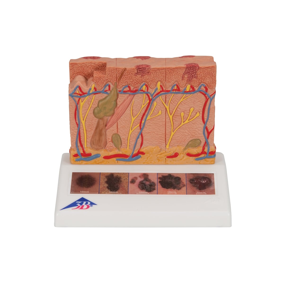 3B Scientific Skin Cancer Training Model, 5 Stages Magnified, W19000