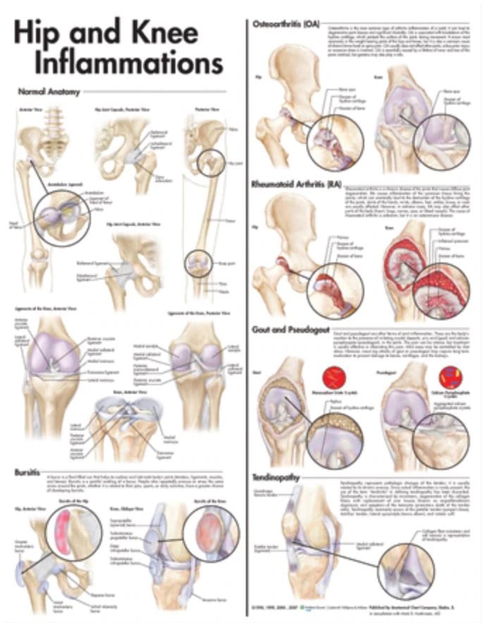 Hip and Knee Inflammations Anatomical Chart, 20" x 26", Flexible, Each