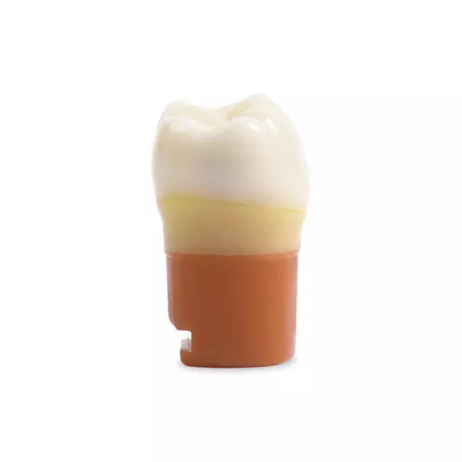 Acadental CompeDont ModuPro One Carious Tooth, Distal #30, Each