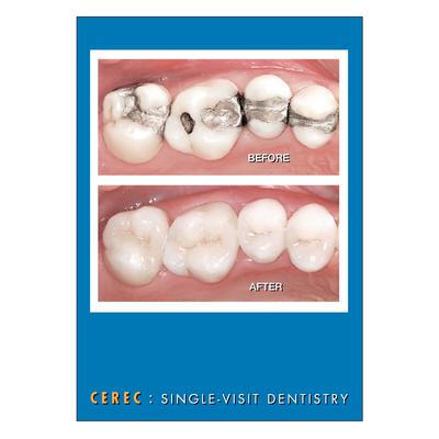 CEREC Postcards, Before & After, 4-1/4" W x 6" H, Full Color, 100/Pkg