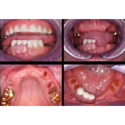 Dr. Christensen's Restoring Mini Implants DVD