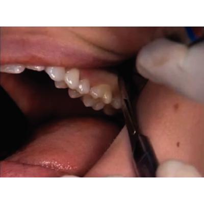Dr. Christensen's Easy Third Molar Extraction DVD