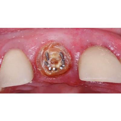 Dr. Christensen's How to Repair and Maintain Fixed Restorations DVD