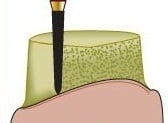 Alpen® Multi Use Diamond Bur, FG, Super Coarse, Black Ring, Cone, Curettage/Tapered Pointed End, #878K, 2.3 mm Diameter, 8.0 mm Length, 5/Pkg