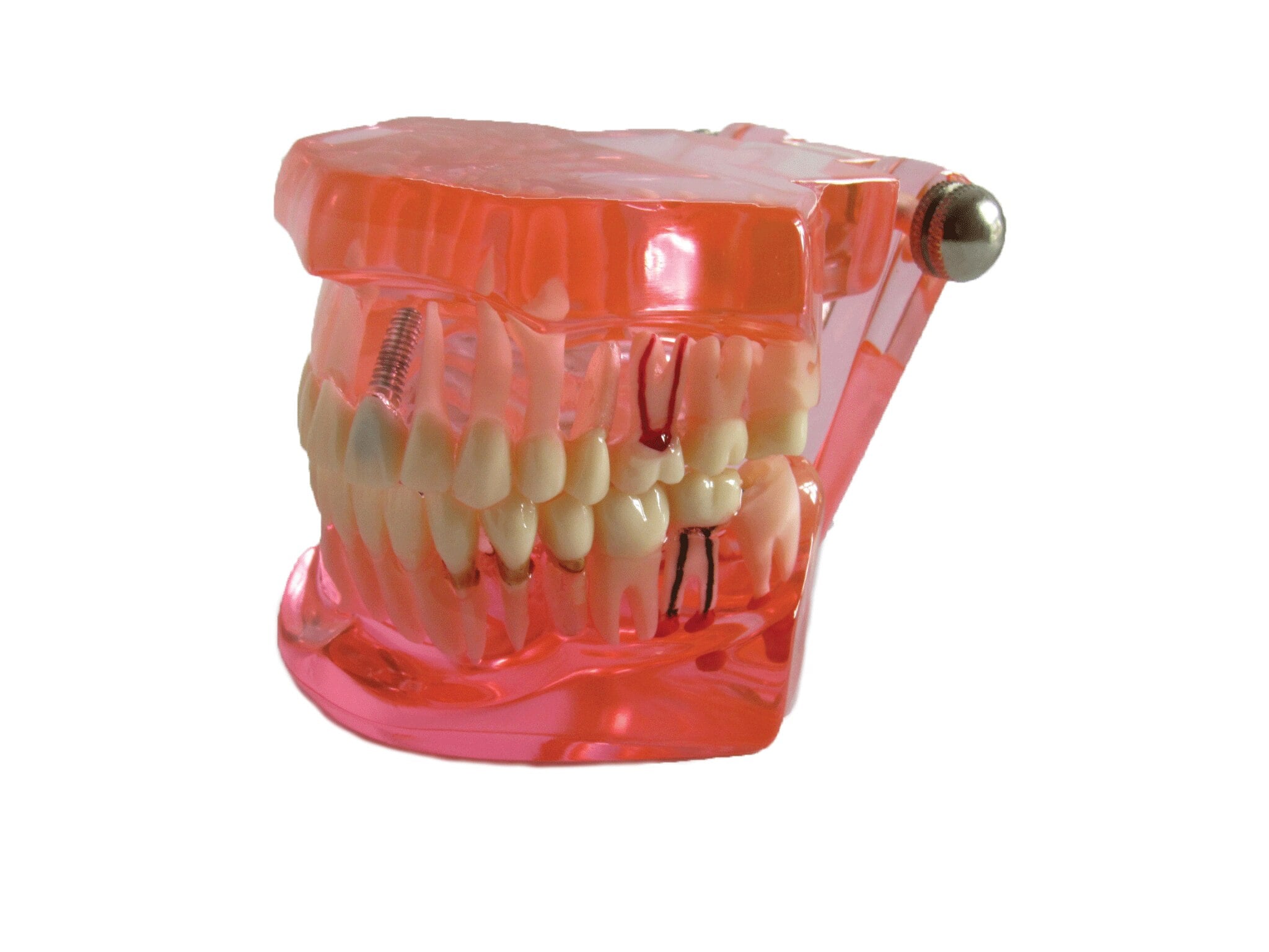 Educational Restoration Model with Implant