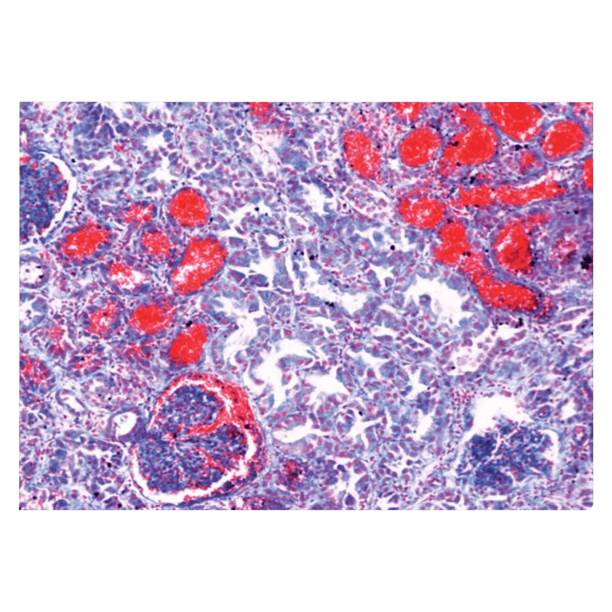 Johannes Lieder Diseased Human Tissue Educational Slide Set, 15 Piece Mounted Human Pathology, 01KT0J09BYZTC14EB0JW8T5M3H - Slide Set Edctnl Human Pathlgy - Image 1