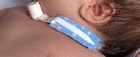 Dale Medical Tracheostomy Tube Holder, Neonatal/Infant, Disposable, <9", 10/Box - Holder Trach Tube Neonatal - Image 1
