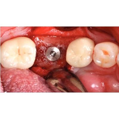 Dr. Christensen's Simplified Implant Surgery DVD - Dr. Christensen's Simplified Implant Surgery DVD - Dr. Christensen's Simplified Implant Surgery DVD - Image 1