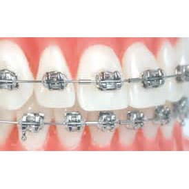 3B Orthodontics TOL 0.015 Mini Crimpable Stop, 10/Bag - TOL 0.015 Mini Crimpable Stop 10/Bag. Typically placed on each side - Image 1