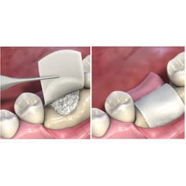 MatrixDerm EXT Regenerative Collagen Dental Membrane, 30mm x 40mm, White, 1/Box - MatrixDerm EXT regenerative collagen dental membrane 30mm x 40mm, 1/Box. White - Image 1