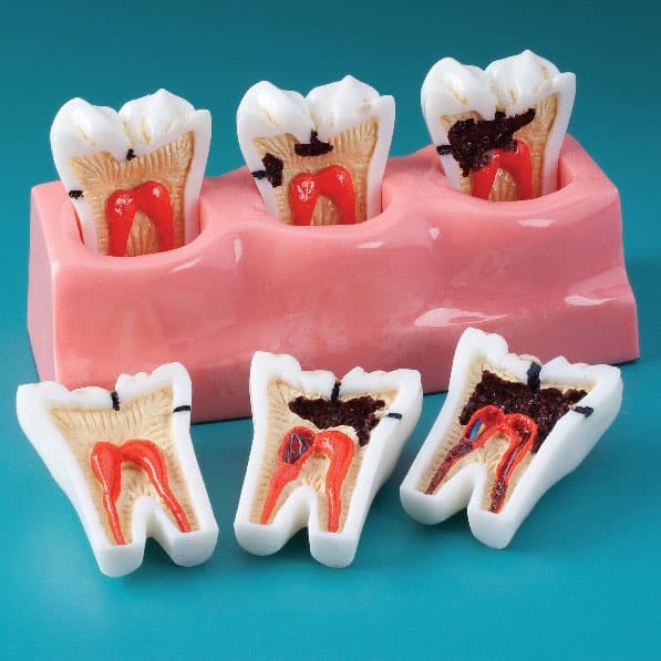 MDO Caries Progression Model, 3 Removable Super-Sized Lower Left Molars on Acrylic Base, 5-1/2" Long - Caries Progression Model - Image 1