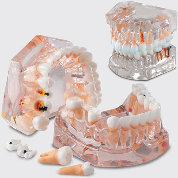 MDO DI Enlarged Model for Hygiene and Caries Evolution, Upper and Lower Arch with 32 Removable Teeth, 4-1/4"W x 3-1/2"H - Enlarged Model For Hygiene And Caries Evolution - Image 1