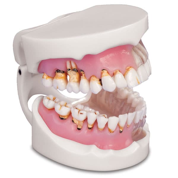 MDO Pathological Gingivitis Model, Upper and Lower Arch with 32 Removable Teeth, Life-Sized - MDO DI Pathological Gingivitis Model. The MDO Pathological Gingivitis Model - Image 1