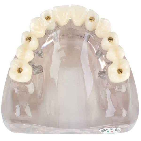 MDO DI Screw-Retained Full Arch Implant Model with Six Fixed Implants, Life-Sized Anatomical Base, Screwdriver Included - MDO DI Screw-Retained Full Arch Implant Model. Features six fixed implants - Image 1